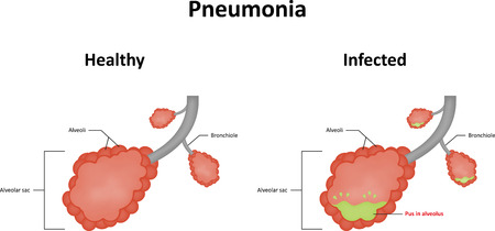 Pneumoniaのイラスト素材