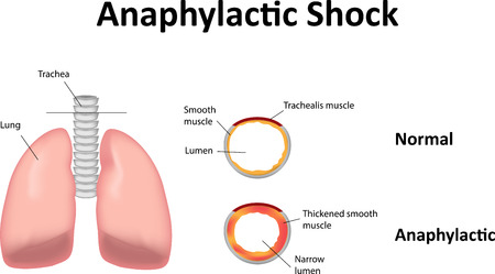 Anaphylactic Shockの写真素材