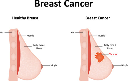 Breast Cancerの写真素材