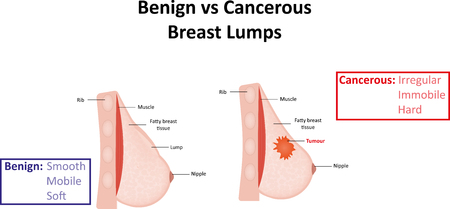 Benign and Cancerous Breast Lumpのイラスト素材