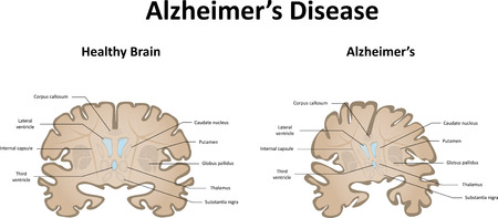 Alzheimer's Diseaseの写真素材