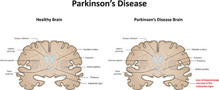 Parkinson's Diseaseのイラスト素材