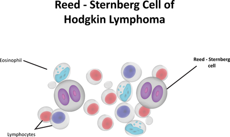 Reed Sternberg Cell Hodgekin Lymphomaの写真素材