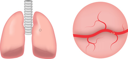 Pulmonary Emoblismの写真素材