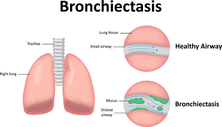 Bronchiectasis Labeled Diagramのイラスト素材