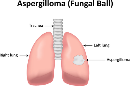 Aspergilloma (Fungal Ball)の写真素材