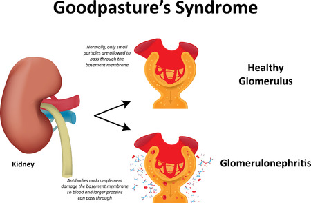 Goodpasture's Syndromeの写真素材