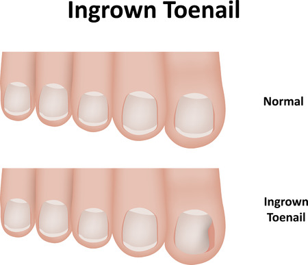 Ingrown Toenailのイラスト素材