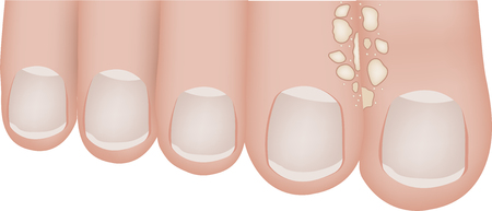 Athlete's Footのイラスト素材