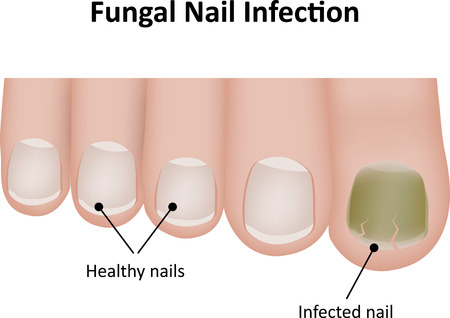 Fungal Nail Labeled Illustrationのイラスト素材
