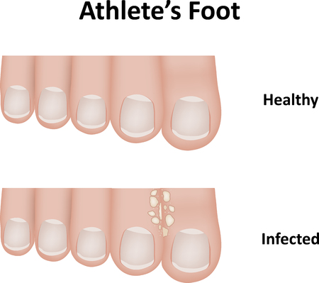 Athlete's Foot Illustrationのイラスト素材