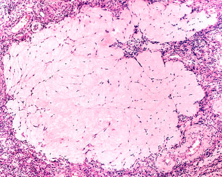 Corpus albicans. Human ovary. The corpus albicans is the regressed form of the corpus luteum. After...