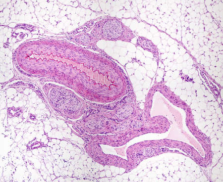 Muscular artery, vein and nerve bundles surrounded by adipose tissue. The artery is identified as having a thicker wall and a smaller diameter than the vein. Light microscope micrograph. Hematoxylin & eosin stainの写真素材