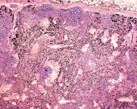 Anthracotic lymph node. Accumulation of carbon is most commonly found in intrapulmonary lymph nodes, due to coal dust, smoke or pollution. H & E stainの写真素材