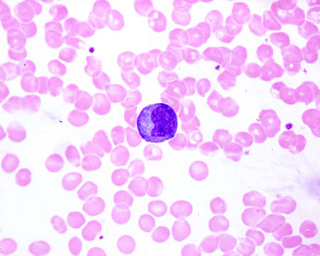Human blood smear showing a monocyte with a basophilic cytoplasm in an infectious mononucleosis. It is the largest leukocyte (compare with red blood cell size).の写真素材
