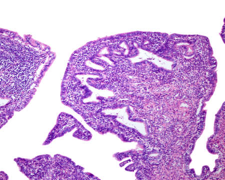 Human fallopian tube affected by chronic salpingitis. The mucosal folds are widened and shortened, and the lamina propria shows chronic inflammatory infiltrates.