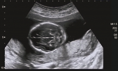 Ultrasonography Analysis of a 4th Month Fetus, Italy