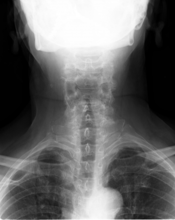 Spinal Column Back Upper Part xray medical imageの写真素材