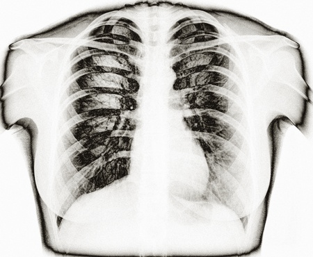 X-Ray Image Of Human Healthy Chest MRIの写真素材