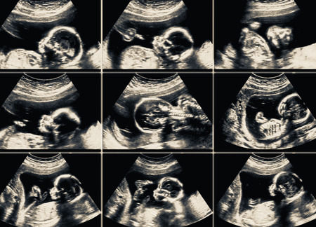 Ultrasound scans collage during pregnancy at the end of third month.
