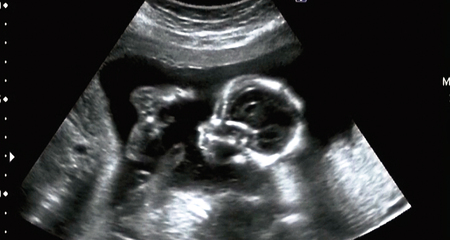 Ultrasonography Analysis of a 4th Month Fetus, Italy