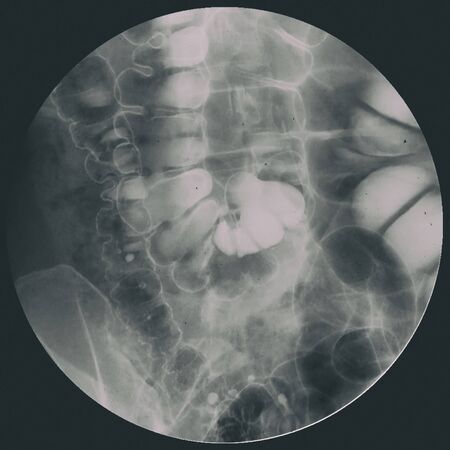 Barium enema image or colorectal x-ray view showing anatomical of large intestine or colon for...