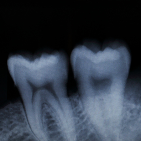 it is teeth x-ray for pattern and design.の写真素材