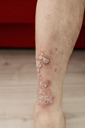 Acute psoriasis on the legs is an autoimmune incurable dermatological skin disease. A large red,...