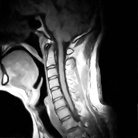 cervical spine nuclear magnetic resonance imageの写真素材