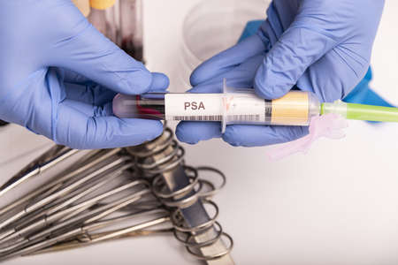 Blood sample with abnormal high PSA test result.の写真素材