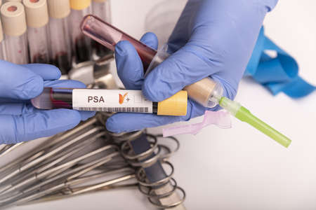 Blood sample with abnormal high PSA test result.の写真素材