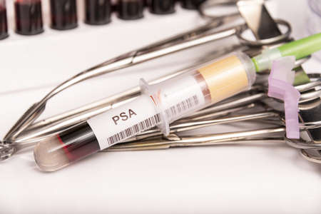 Blood sample with abnormal high PSA test result.の写真素材