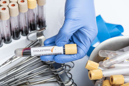 Blood sample tube with abnormal high cholesterol test result.の写真素材
