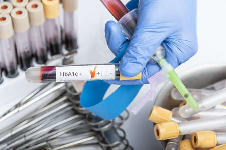 Blood sample for HbA1c test, diabetes diagnosis.の写真素材