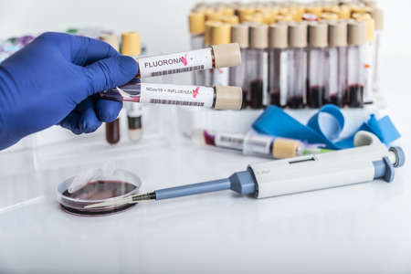 Doctors hands hold blood samples of the new variant omicron plus flu FLUORONE, covid19, coronavirus. Selective approach to the sample tube.の写真素材