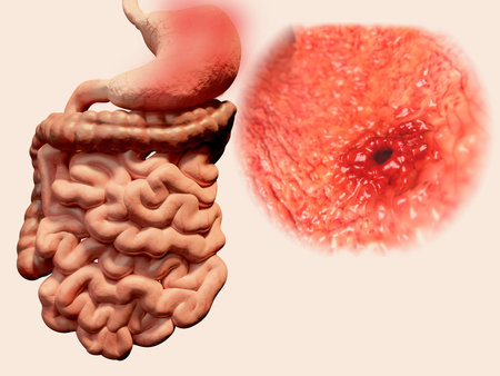 Peptic ulcer