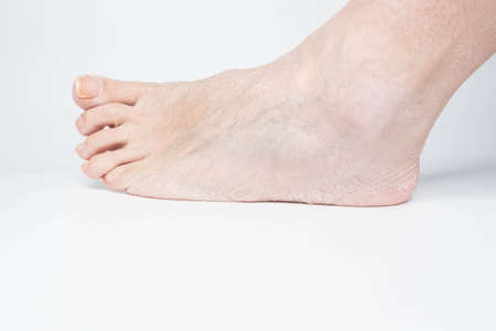 Close-up view female sore skin of feet, dry heels isolated on a white backgroundの写真素材