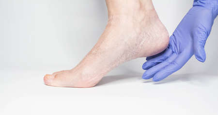 Doctor examines the patient's leg in blue gloves. The heel is all blistered and cracked. close-up.の写真素材