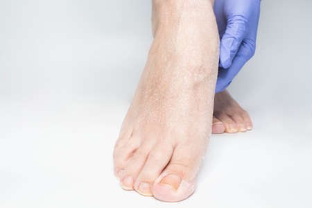 Doctor examines the patient's leg in blue gloves. The heel is all blistered and cracked. close-up.の写真素材