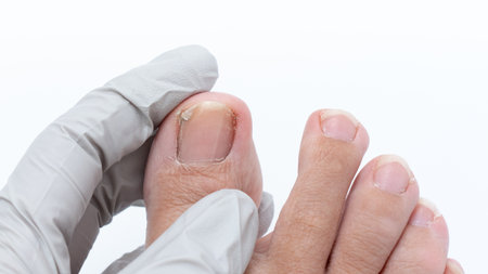 Close-up view of toenail fungus being examined by a gloved hand, showcasing the condition's effects on foot health and personal careの写真素材