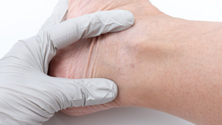 Medical examination of varicose veins and spider veins on legs, featuring gloved hand assessing skin texture, emphasizing treatment options and health awarenessの写真素材
