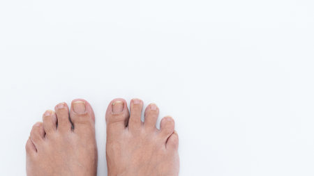 Close-up of human feet showing ingrown toenails against a pristine white background, emphasizing foot care and common health concernsの写真素材