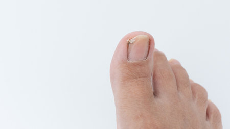 Close-up view of a toe with a damaged nail, illustrating trauma and the healing process, highlighting the importance of foot care and health awarenessの写真素材