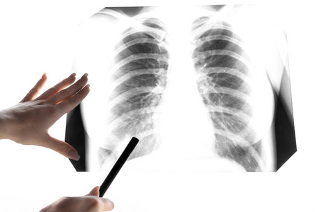 A snapshot of the lungs. Fluorography. X-ray shows lungs with pneumonia. Chest x-ray into the lumen...
