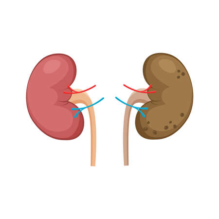 Normal healthy and unhealthy polycystic kidneys. Polycystic kidney disease. Internal human organs icon. Anatomy urology or nephrology logo. Vector illustration isolated on white background.のイラスト素材