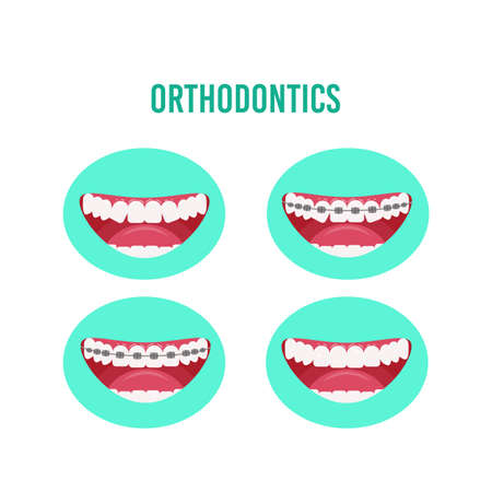 Orthodontic treatment with dental braces, stages of the teeth alignment process. Vector illustration in a flat style isolated on a white backgroundのイラスト素材