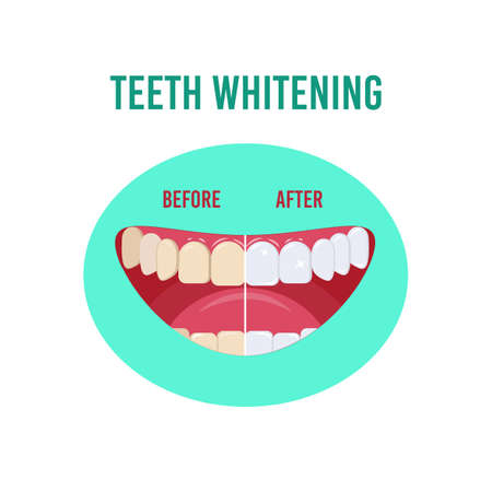 Before and after teeth whitening. Vector illustration isolated on a white backgroundのイラスト素材