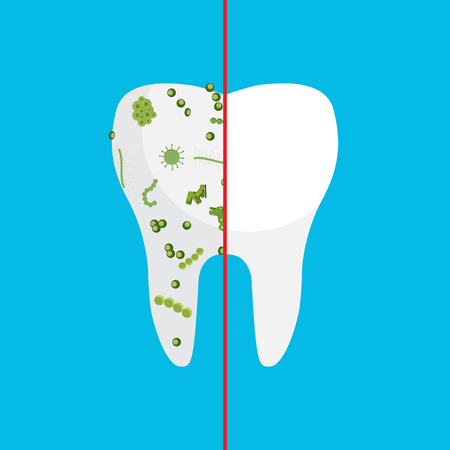Bacteria on a human white tooth being viewed on a magnifying glass. Vector illustrationのイラスト素材