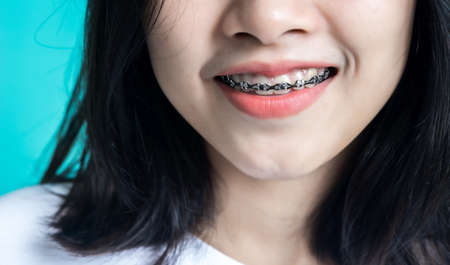 Asian woman wearing detal braces pointing to tooth sample and smiling with her healthy white teeth isolated shot on blue blackground.の写真素材