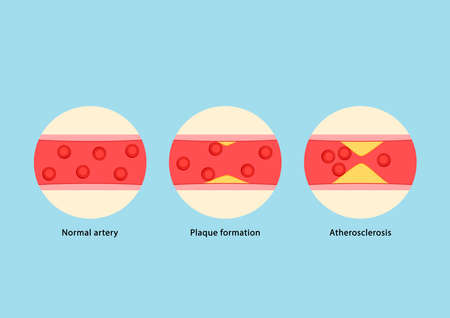 Blood vessel. Atherosclerosis Infographics with Tiny Medic Characters Presenting Human Blood Artery Normal, Plaque Formation and Vessel Blocked with Cholesterol.のイラスト素材